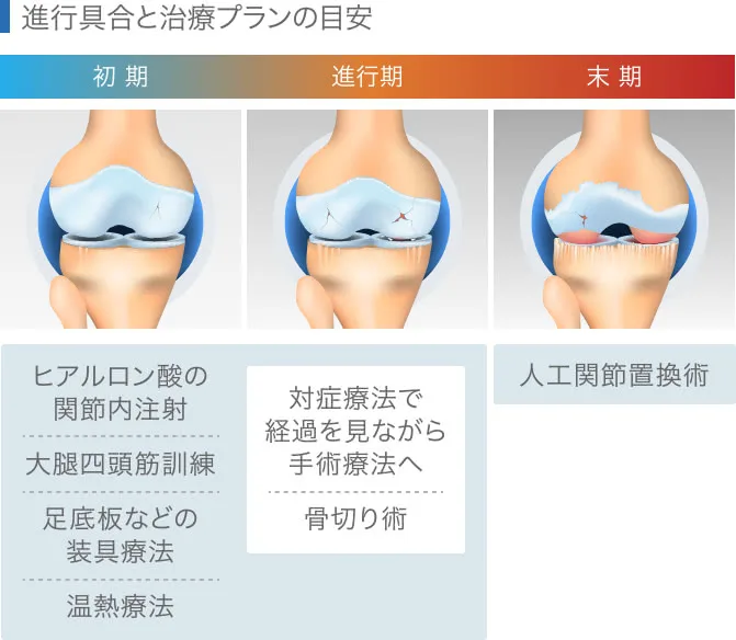 変形性膝関節症とは｜整形外科・再生医療｜札幌ひざ関節症クリニック