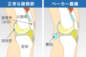 膝裏が痛むのですが どんな病気が考えられますか 札幌ひざ関節症クリニック 公式